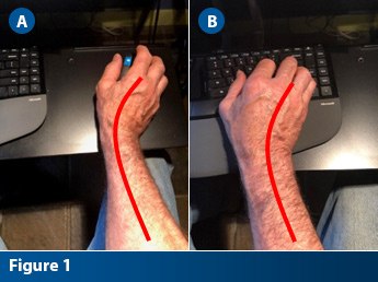 Comparison showing TFCC compression on adult hand while using computer keyboard